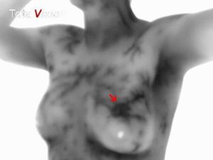 Breast cancer detected on thermography screen