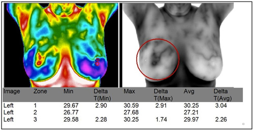 Breast Thermography Imaging