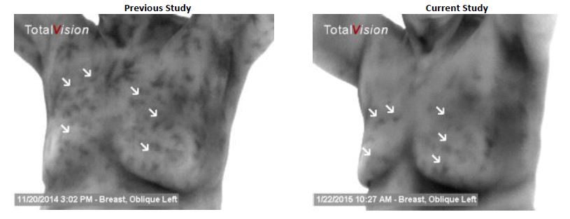 Before and after breast detoxification