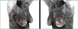 thermography of breast