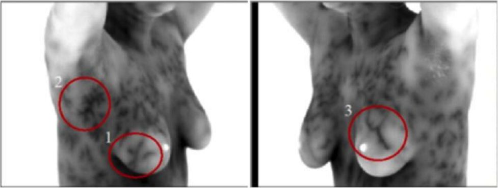 thermography of breast