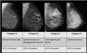 Dense breast mammo