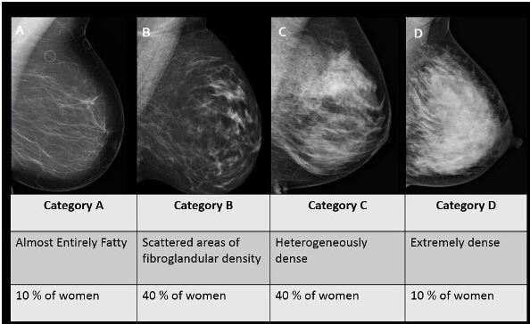 Dense breast mammo