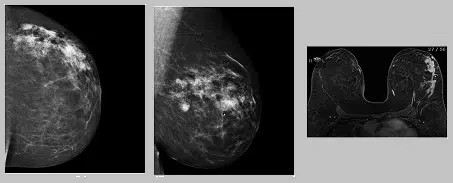 breast-cancer-mammogram