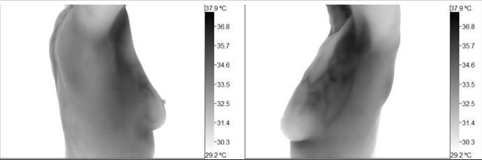 Thermographic image of lymphatic drainage
